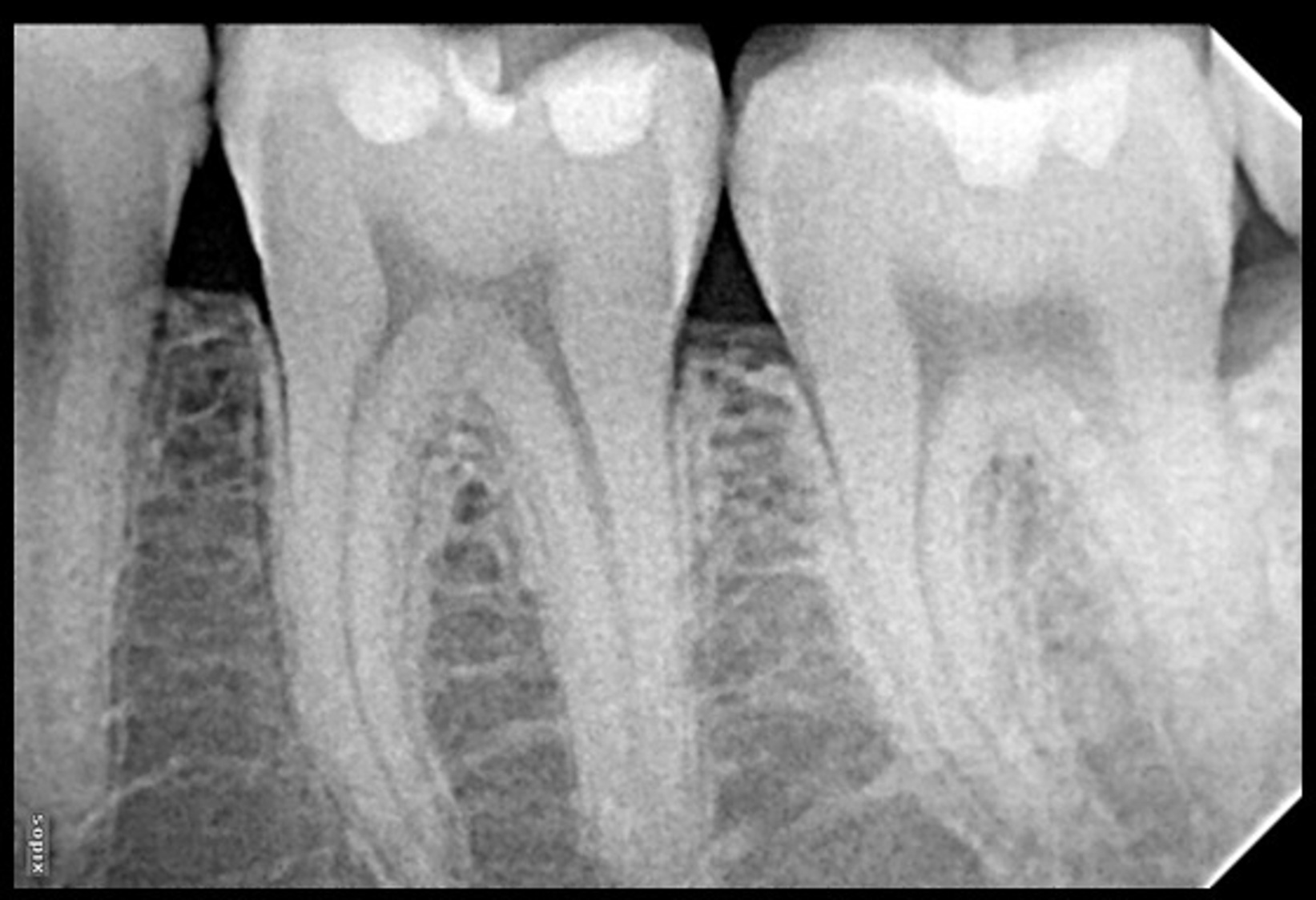 radiografia periapical dental