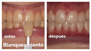 blanqueamiento-dental-tortosa