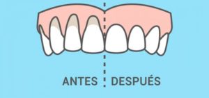 retraccion gingival