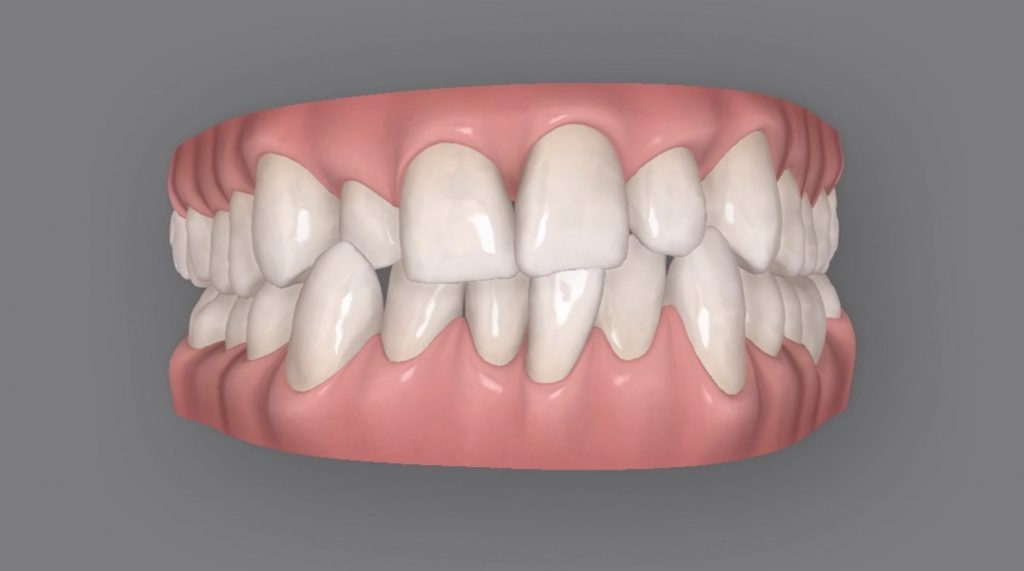 El apiñamiento dental - Sheila Martín Dental