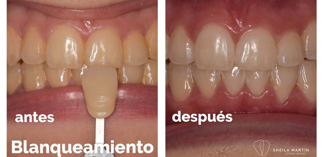 blanqueamiento-dental-tortosa