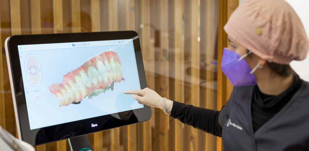 escaner dental iTero