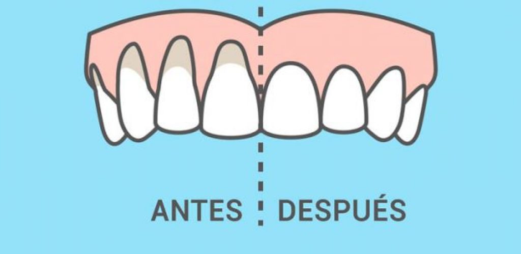 retraccion gingival